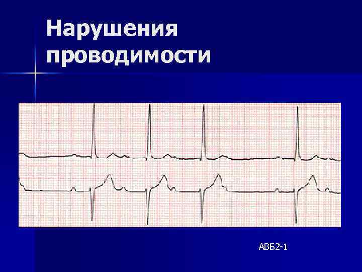 Нарушения проводимости АВБ 2 -1 