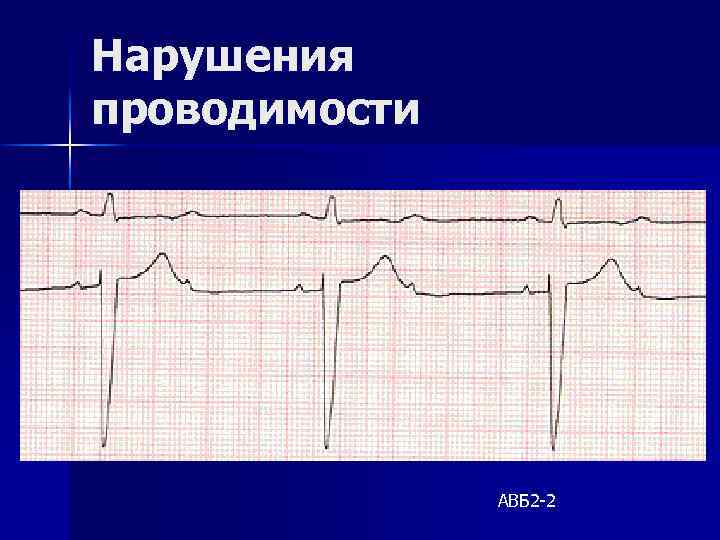 Нарушения проводимости АВБ 2 -2 