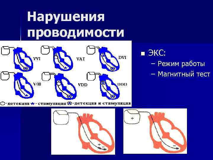 Нарушения проводимости n ЭКС: – Режим работы – Магнитный тест 