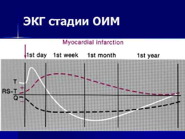 ЭКГ стадии ОИМ 