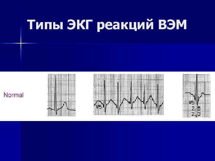 Типы ЭКГ реакций ВЭМ 