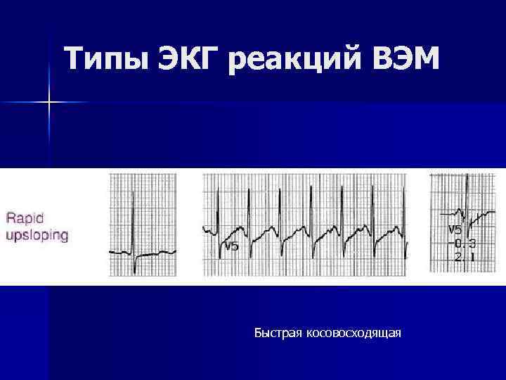 Типы ЭКГ реакций ВЭМ Быстрая косовосходящая 