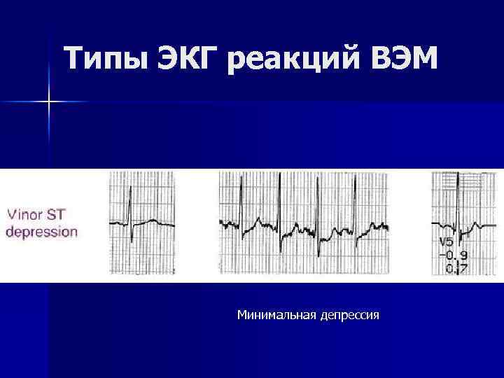 Типы ЭКГ реакций ВЭМ Минимальная депрессия 