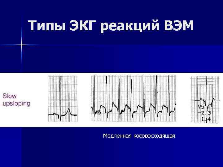 Типы ЭКГ реакций ВЭМ Медленная косовосходящая 