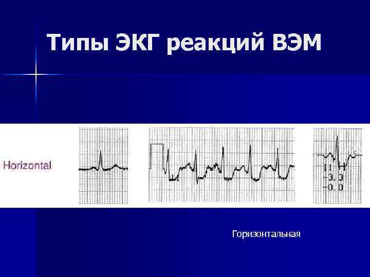 Типы ЭКГ реакций ВЭМ Горизонтальная 