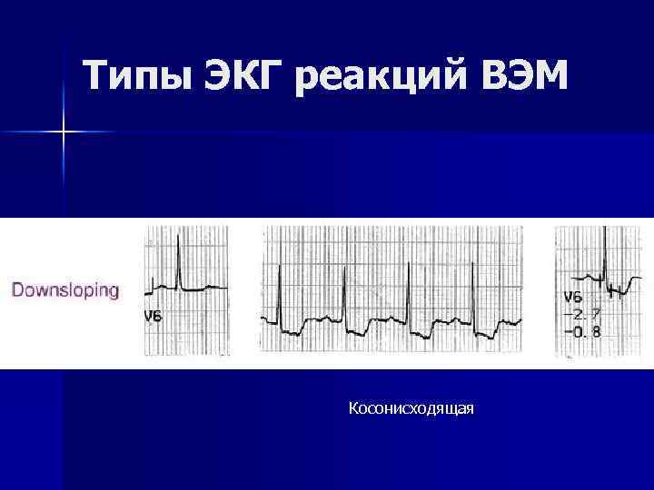 Типы ЭКГ реакций ВЭМ Косонисходящая 