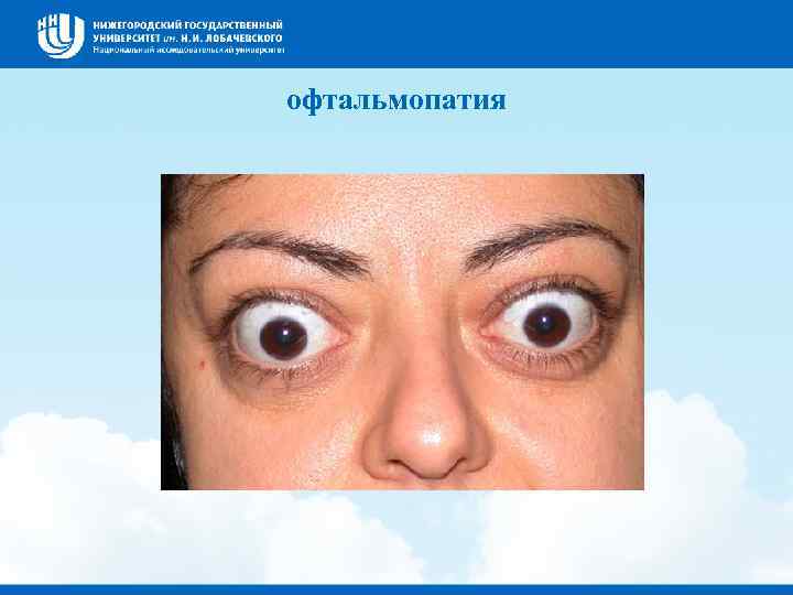 офтальмопатия 