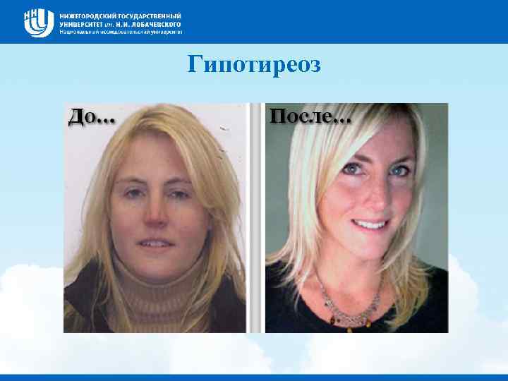 Гипотиреоз 