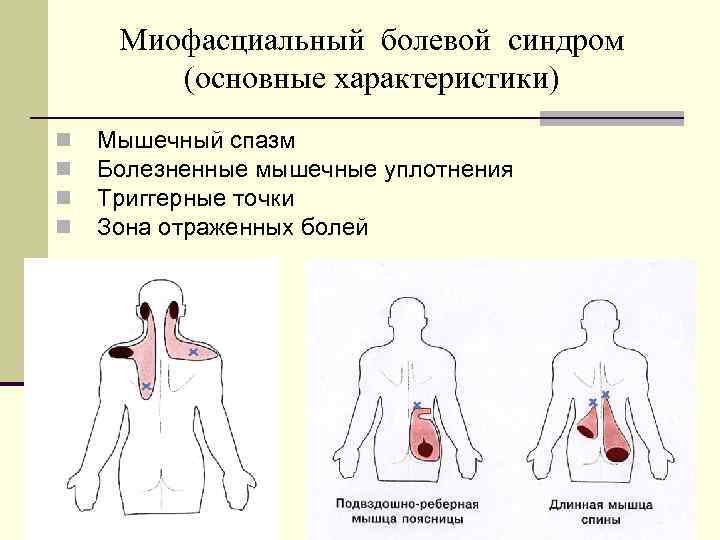 Миофасциальный болевой синдром. Болезненные мышечные уплотнения. Болезненные мышечные уплотнения Иваничев. Миофасциальный синдром физиотерапия. Миофасциальный синдром зоны отраженной боли.