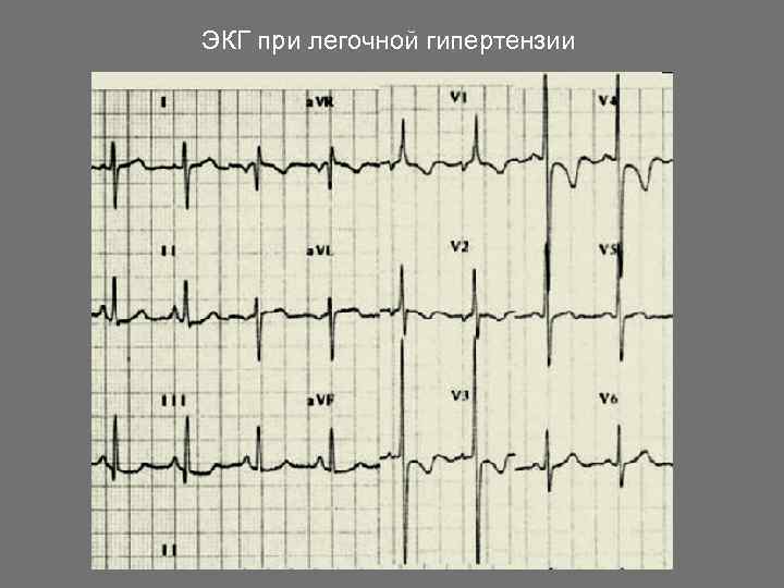 ЭКГ при легочной гипертензии 