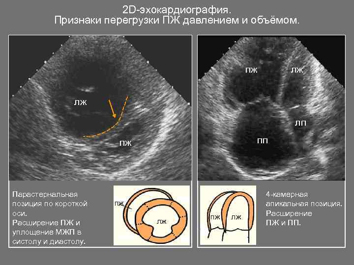 2 D-эхокардиография. Признаки перегрузки ПЖ давлением и объёмом. пж пж лж лж лп пж