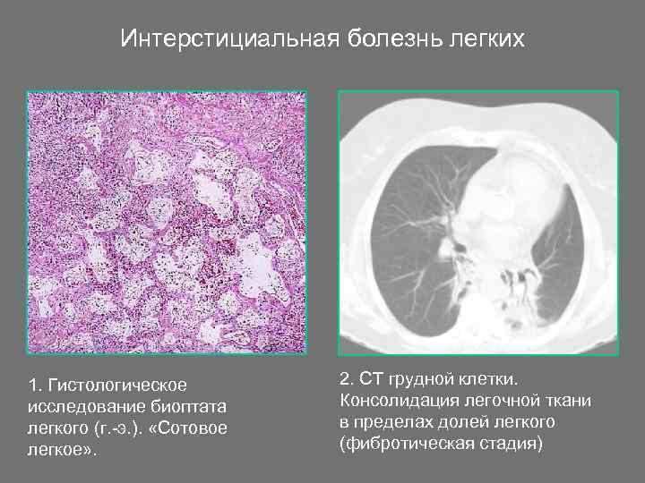 Интерстициальная болезнь легких 1. Гистологическое исследование биоптата легкого (г. -э. ). «Сотовое легкое» .