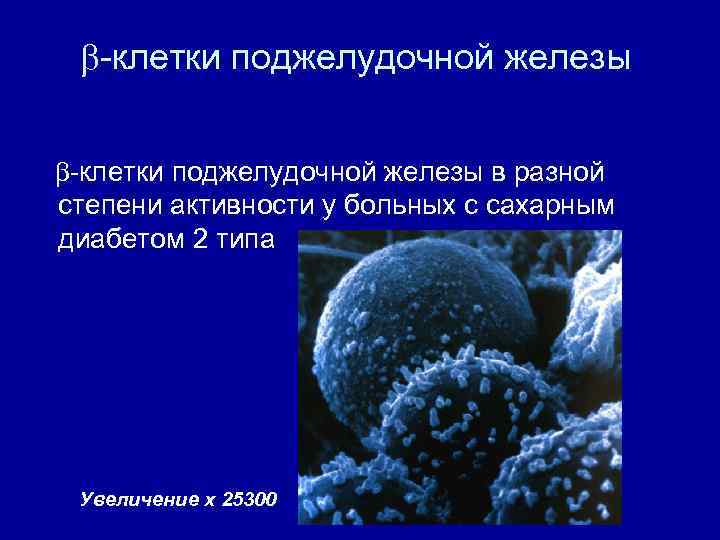  клетки поджелудочной железы в разной степени активности у больных с сахарным диабетом 2