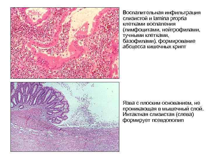 Воспалительная инфильтрация слизистой и lamina propria клетками воспаления (лимфоцитами, нейтрофилами, тучными клетками, базофилами), формирование