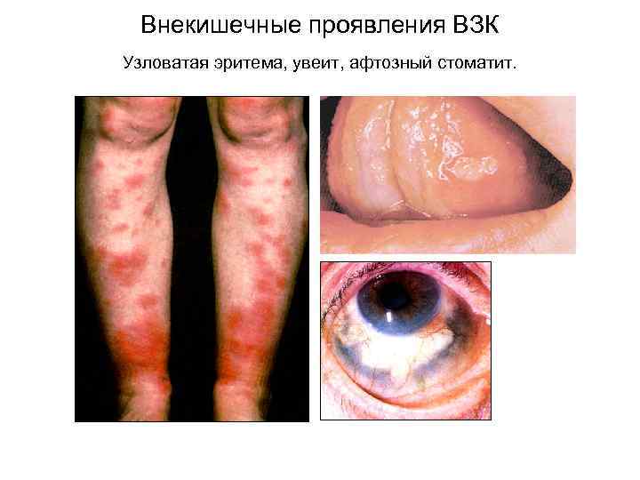 Внекишечные проявления ВЗК Узловатая эритема, увеит, афтозный стоматит. 