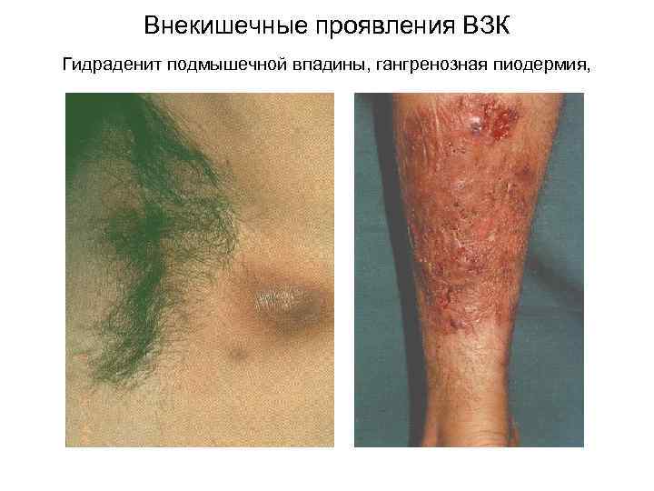 Внекишечные проявления ВЗК Гидраденит подмышечной впадины, гангренозная пиодермия, 