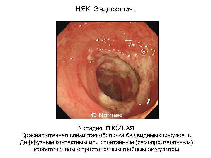 НЯК. Эндоскопия. 2 стадия. ГНОЙНАЯ Красная отечная слизистая оболочка без видимых сосудов, с Диффузным