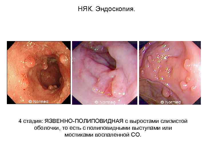 НЯК. Эндоскопия. 4 стадия: ЯЗВЕННО-ПОЛИПОВИДНАЯ с выростами слизистой оболочки, то есть с полиповидными выступами