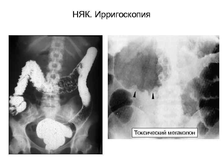 НЯК. Ирригоскопия Токсический мегаколон 