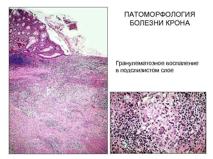 Хроническое гранулематозное воспаление