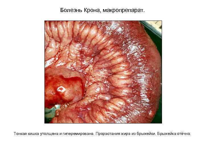 Болезнь Крона, макропрепарат. Тонкая кишка утолщена и гиперемирована. Прорастание жира из брыжейки. Брыжейка отёчна.