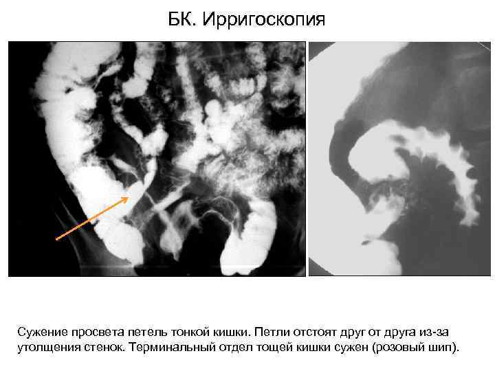 Утолщение стенок прямой кишки