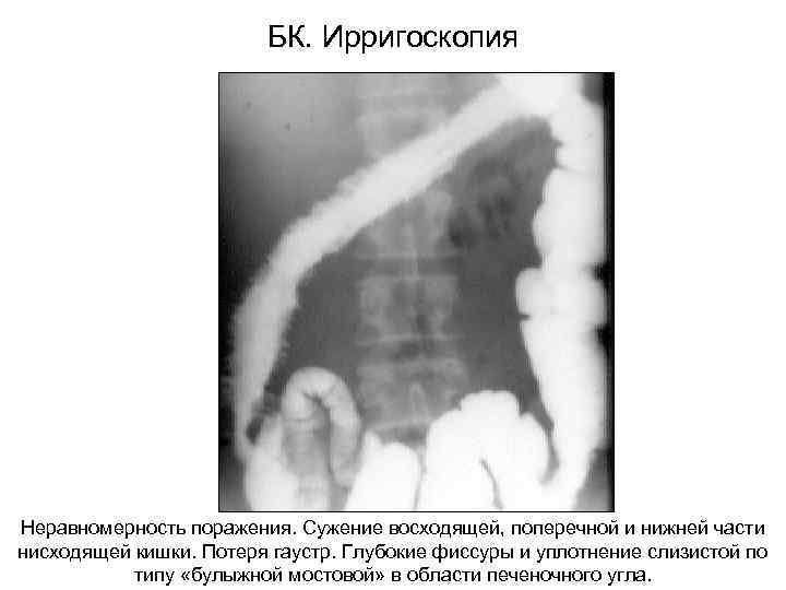 БК. Ирригоскопия Неравномерность поражения. Сужение восходящей, поперечной и нижней части нисходящей кишки. Потеря гаустр.