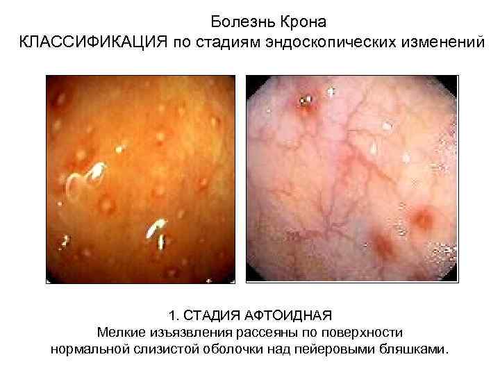Болезнь Крона КЛАССИФИКАЦИЯ по стадиям эндоскопических изменений 1. СТАДИЯ АФТОИДНАЯ Мелкие изъязвления рассеяны по