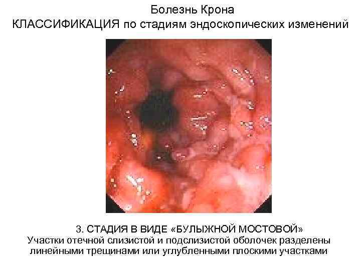 Болезнь Крона КЛАССИФИКАЦИЯ по стадиям эндоскопических изменений 3. СТАДИЯ В ВИДЕ «БУЛЫЖНОЙ МОСТОВОЙ» Участки