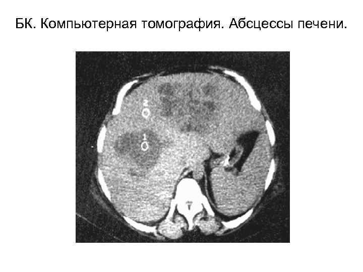 БК. Компьютерная томография. Абсцессы печени. 