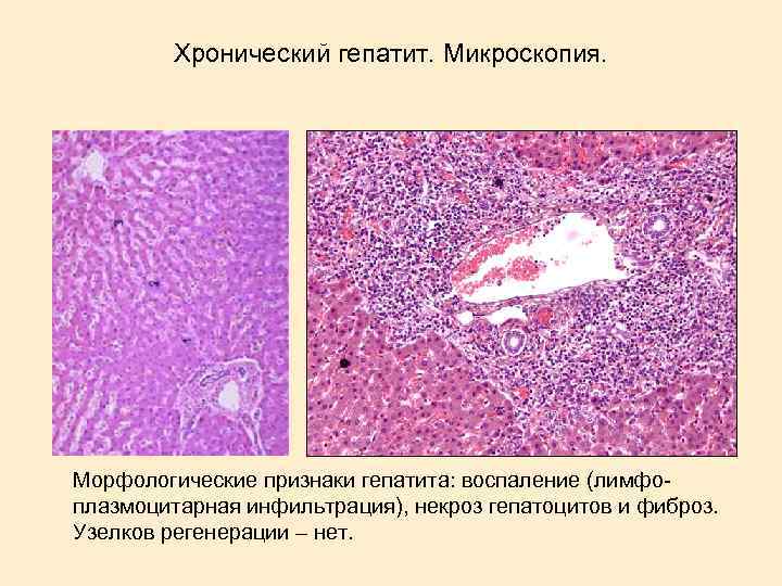 Хронический гепатит. Микроскопия. Морфологические признаки гепатита: воспаление (лимфоплазмоцитарная инфильтрация), некроз гепатоцитов и фиброз. Узелков