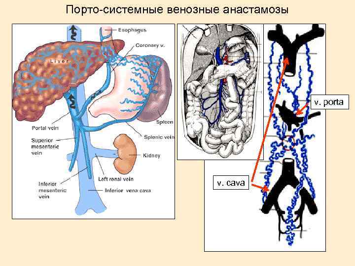 Порто-системные венозные анастамозы v. porta v. cava 