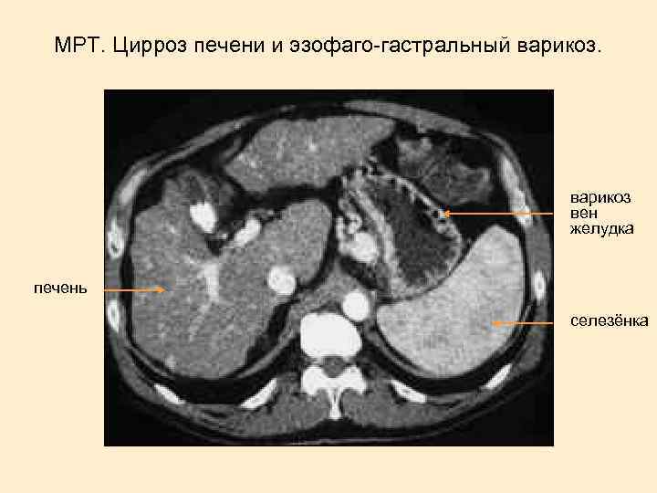 МРТ. Цирроз печени и эзофаго-гастральный варикоз вен желудка печень селезёнка 