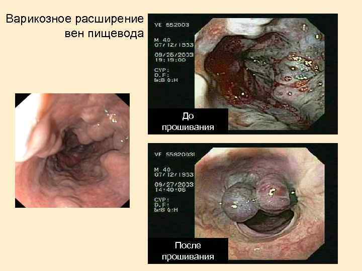 Варикозное расширение вен пищевода До прошивания После прошивания 