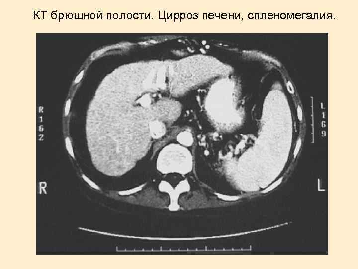КТ брюшной полости. Цирроз печени, спленомегалия. 