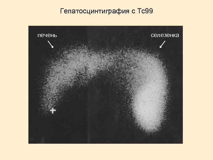 Гепатосцинтиграфия с Tc 99 печень селезенка 
