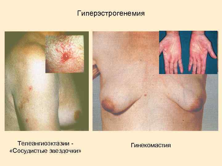 Гиперэстрогенемия Телеангиоэктазии - «Сосудистые звездочки» Гинекомастия 