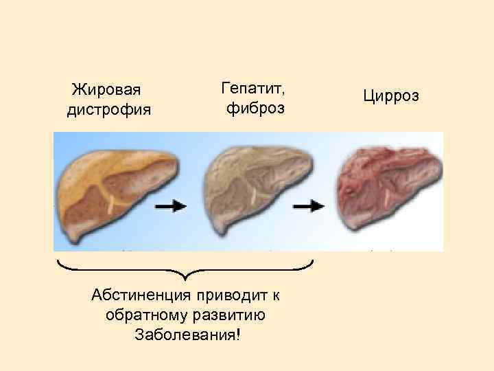 Жировая дистрофия Гепатит, фиброз Абстиненция приводит к обратному развитию Заболевания! Цирроз 