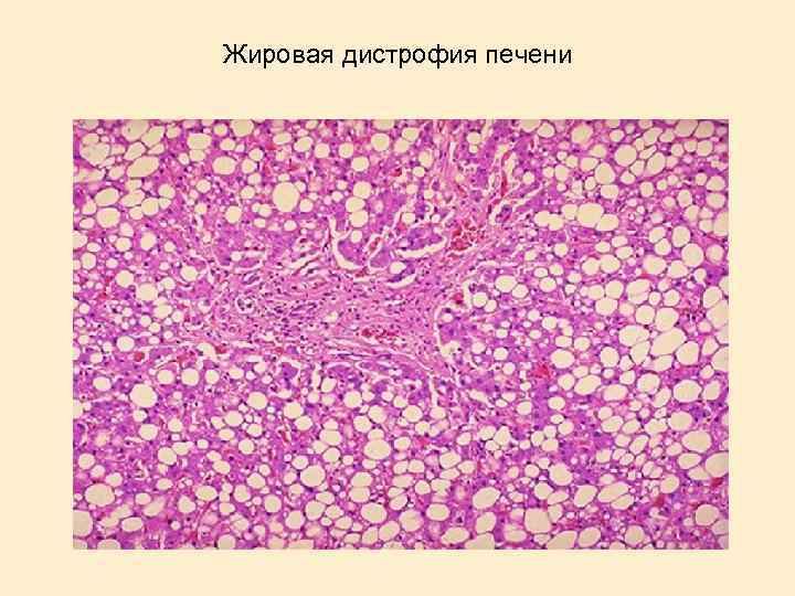 Жировая дистрофия печени 