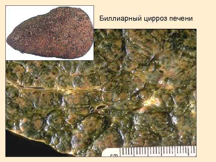 Биллиарный цирроз печени 