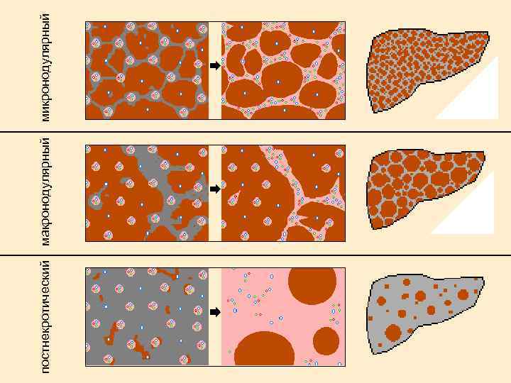 постнекротический макронодулярный микронодулярный 