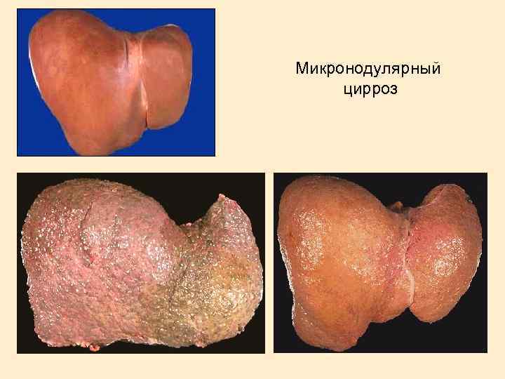 Микронодулярный цирроз 