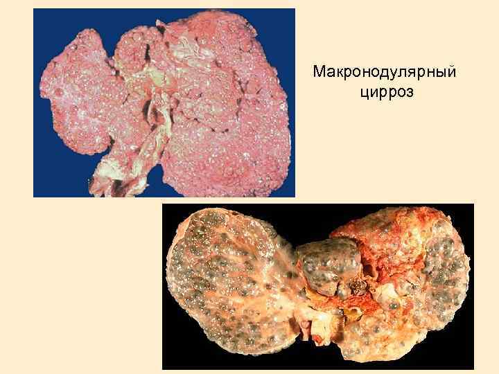 Макронодулярный цирроз 