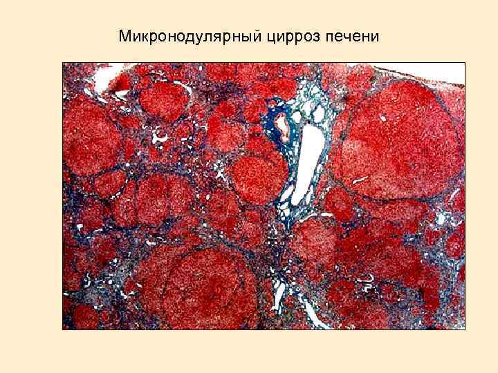 Микронодулярный цирроз печени 