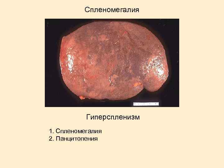 Спленомегалия Гиперспленизм 1. Спленомегалия 2. Панцитопения 