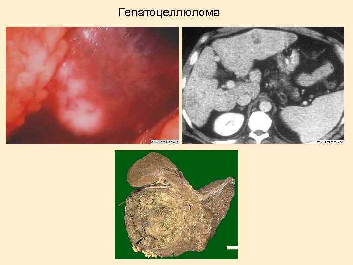 Гепатоцеллюлома 
