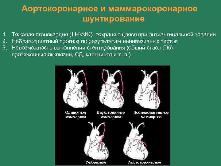 Ишемическая болезнь сердца Эпидемиология — ИБС