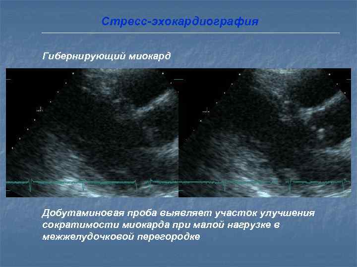    Стресс-эхокардиография  Рубец миокарда Добутаминовая проба не выявляет участок улучшения сократимости