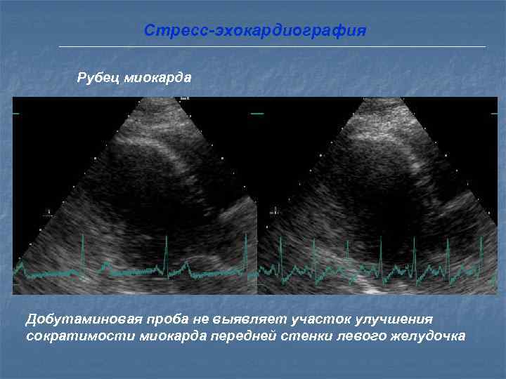   Ишемические синдромы А. Обычные ишемические синдромы • стенокардия напряжения • нестабильная стенокардия