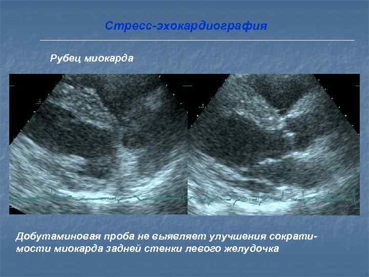 Взаимосвязь оглушенности, прекондиционирования   и гибернации миокарда     Повторные эпизоды